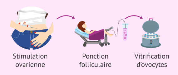 Étapes pour vitrifier ses ovocytes
