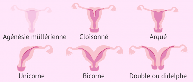 Stérilité féminine due à des malformations