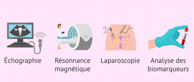 Imagen: Comment diagnostiquer l'endométriose?