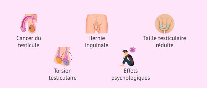 Imagen: Complications de la cryptorchidie
