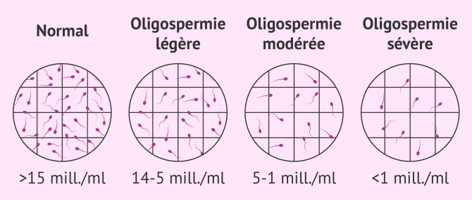 Degrés d'oligospermie observés au microscope