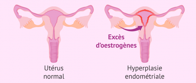 Hyperplasie endométriale
