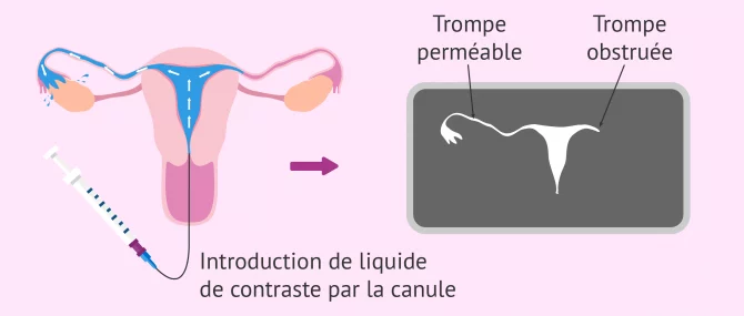 Imagen: Résultat de l'hystérosalpingographie et obstruction tubaire