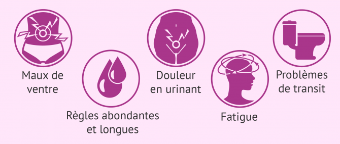Imagen: Symptômes de la patiente atteinte d'endométriose