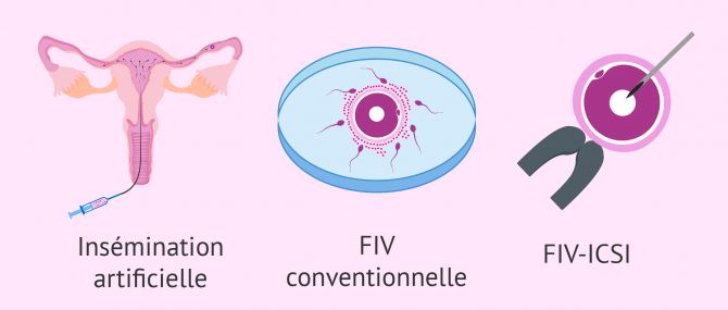Techniques de PMA pour les patients atteints d'oligospermie