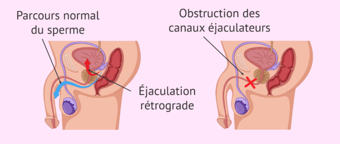 Imagen: Causes de l'aspermie