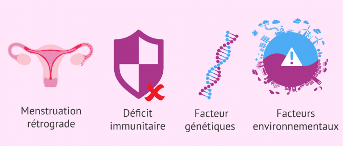 Imagen: causes possibles de l´'endométriose