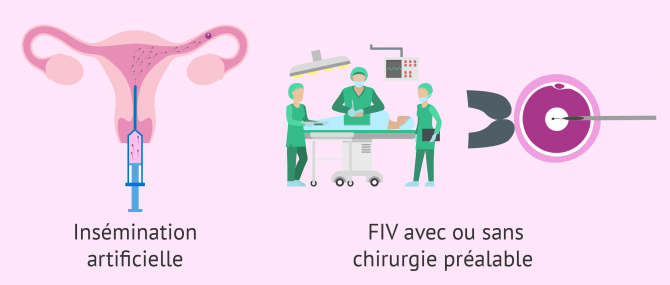 Imagen: traitement fertilite contre endometriose