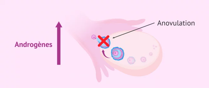 Imagen: androgenes anovulation