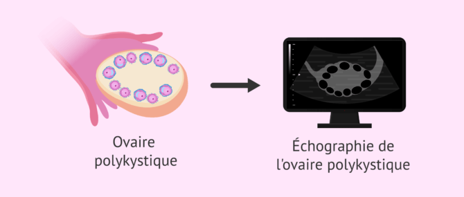 Imagen: Échographie de l'ovaire polykystique