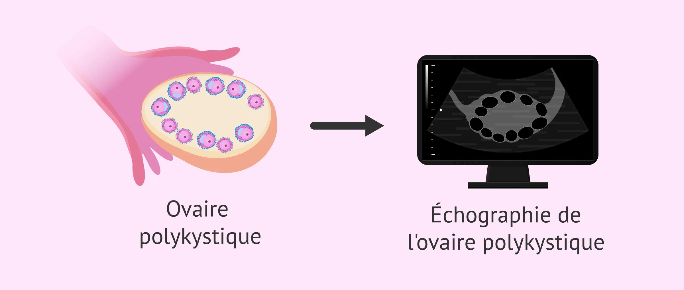 Échographie de l'ovaire polykystique