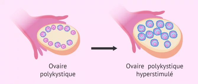 Imagen: ovaire polykistique stimulation