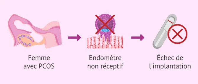 Imagen: Les femmes atteintes du SOPK ont-elles un endomètre réceptif?