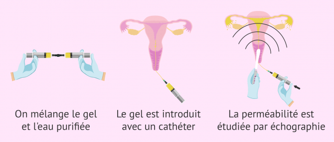 Imagen: procédé de l'HyFoSy avec le kit ExEm Foam Kit