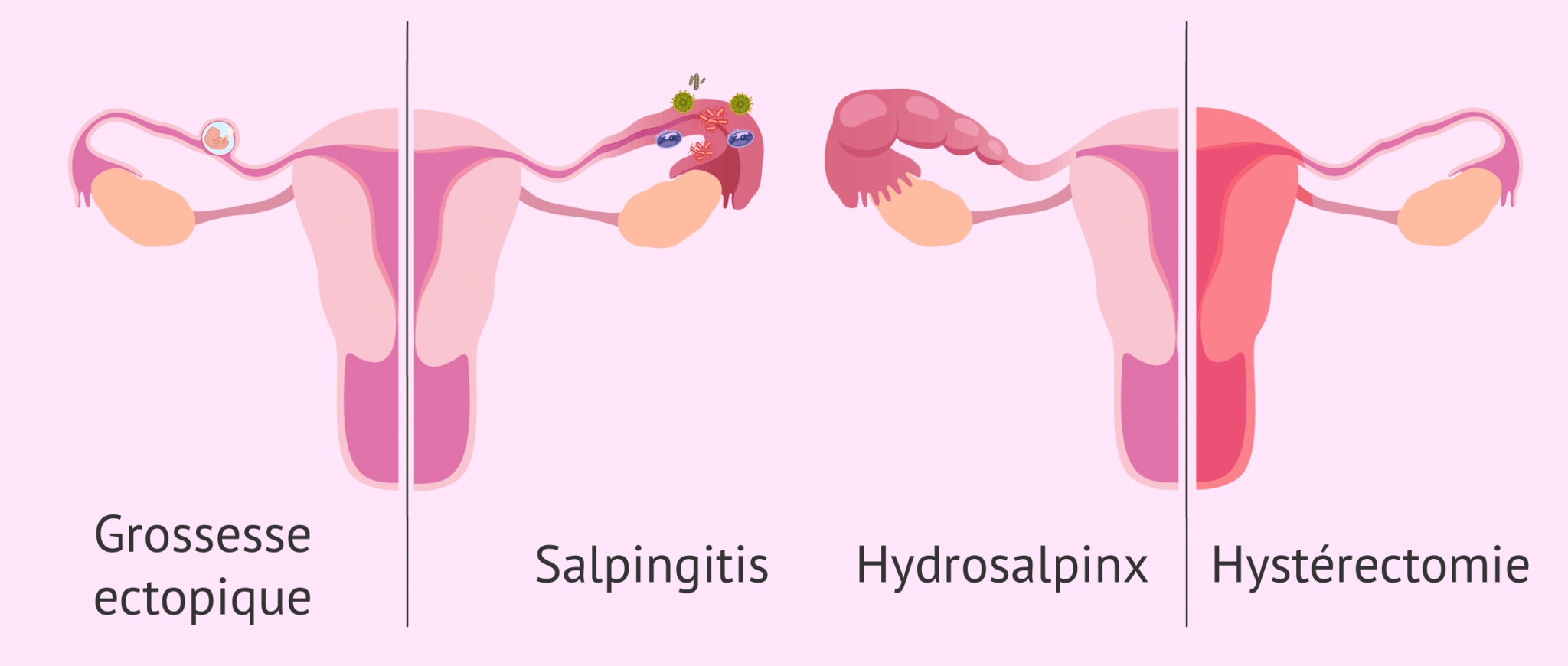 Salpingectomie comment retirer les trompes de Fallope?