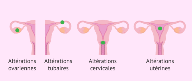 Imagen: Pourquoi l'infertilité féminine se produit-elle?