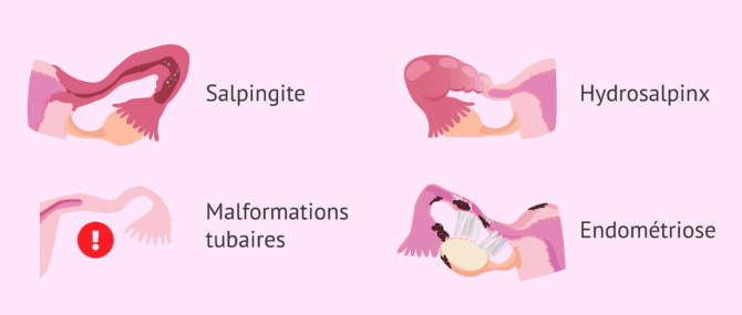 Imagen: Causes du facteur tubaire chez la femme