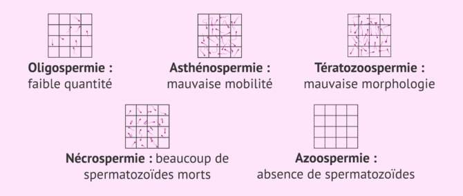 Imagen: Cause spermatique de l'infertilité chez l'homme