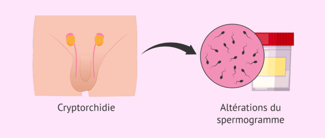 Imagen: La cryptorchidie influence-t-elle la fertilité masculine?