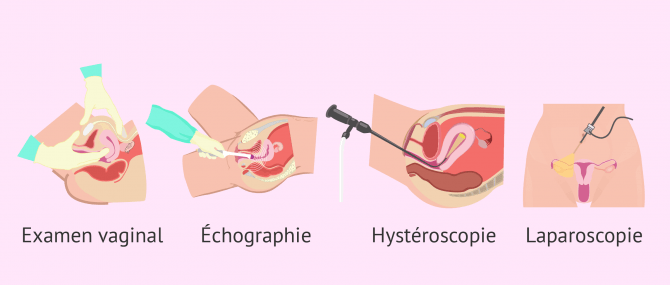 Fibromes utérins: types, symptômes, diagnostic et traitements