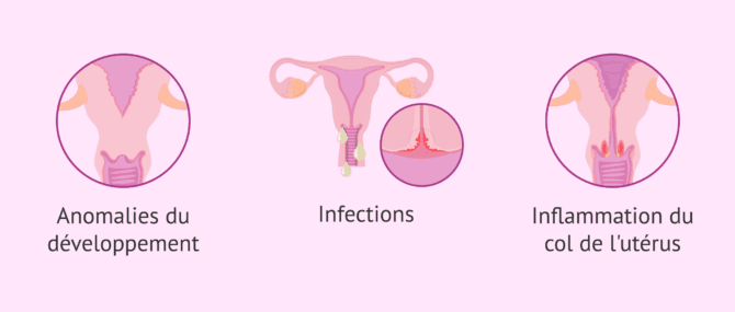 Imagen: Infertilité féminine par facteur cervical