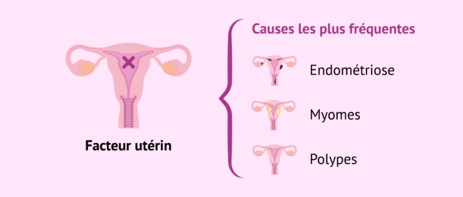 Imagen: Principales causes de l'infertilité féminine par facteur utérin