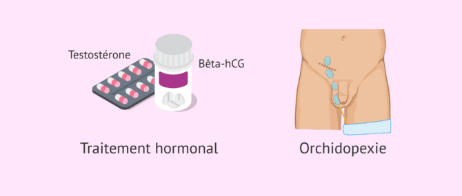Imagen: Traitements possibles de la cryptorchidie