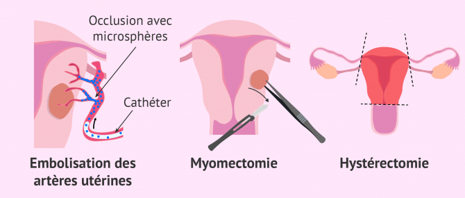 Imagen: Comment traiter les fibromes?