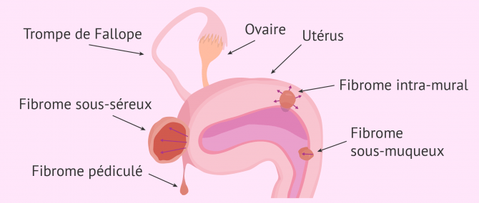 Imagen: Où se situent les fibromes?