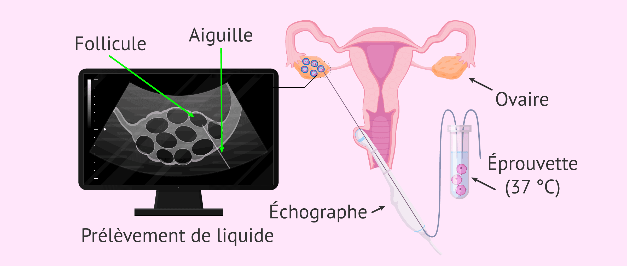 La ponction ovarienne: prélèvement des ovocytes pour une FIV