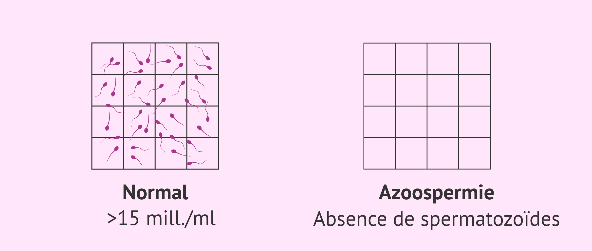 Imagen: Échantillon de sperme normal et échantillon séminal avec azoospermie