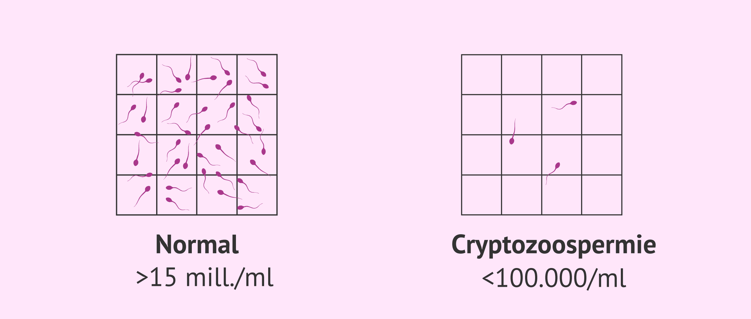 Imagen: Échantillon de sperme normal et échantillon avec cryptozoospermie