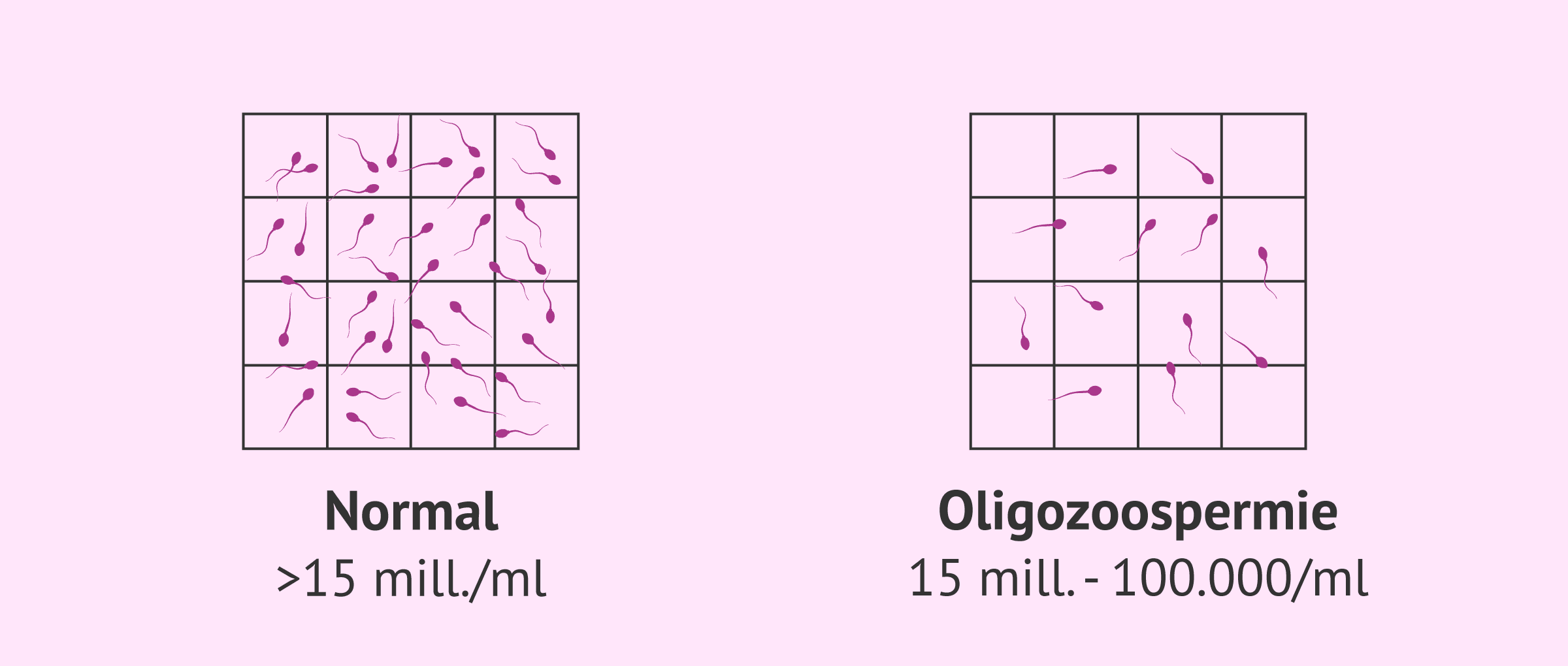 Imagen: Échantillon de sperme normal et échantillon oligozoospermique