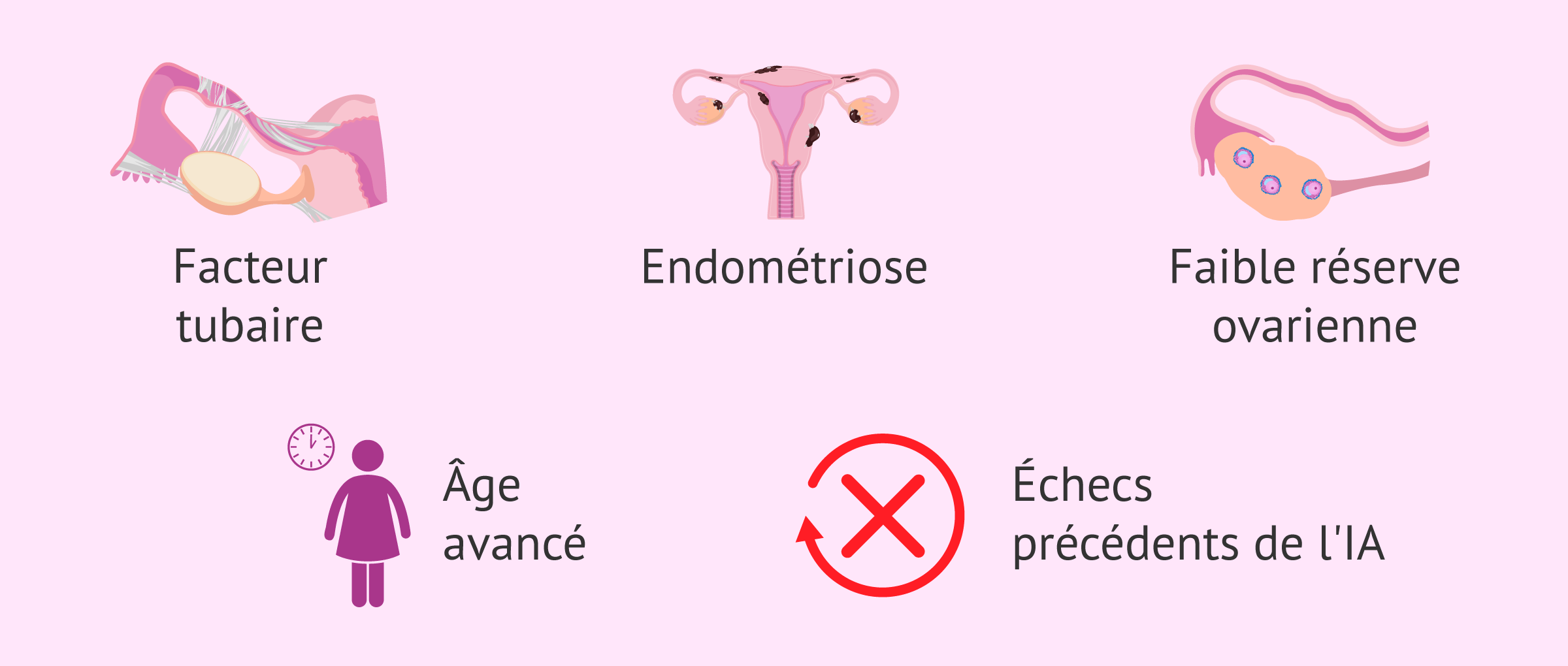 Indications de FIV pour l'infertilité féminine