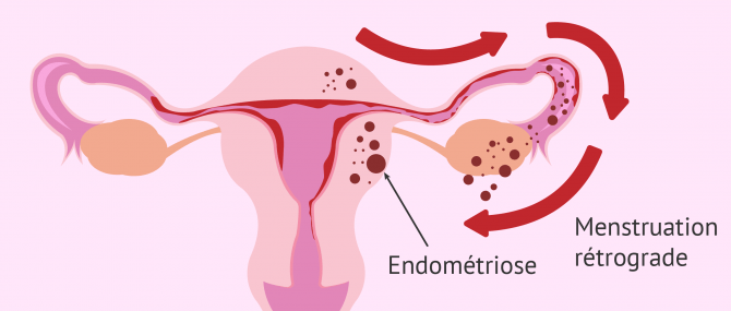 Imagen: Menstruation retrograde