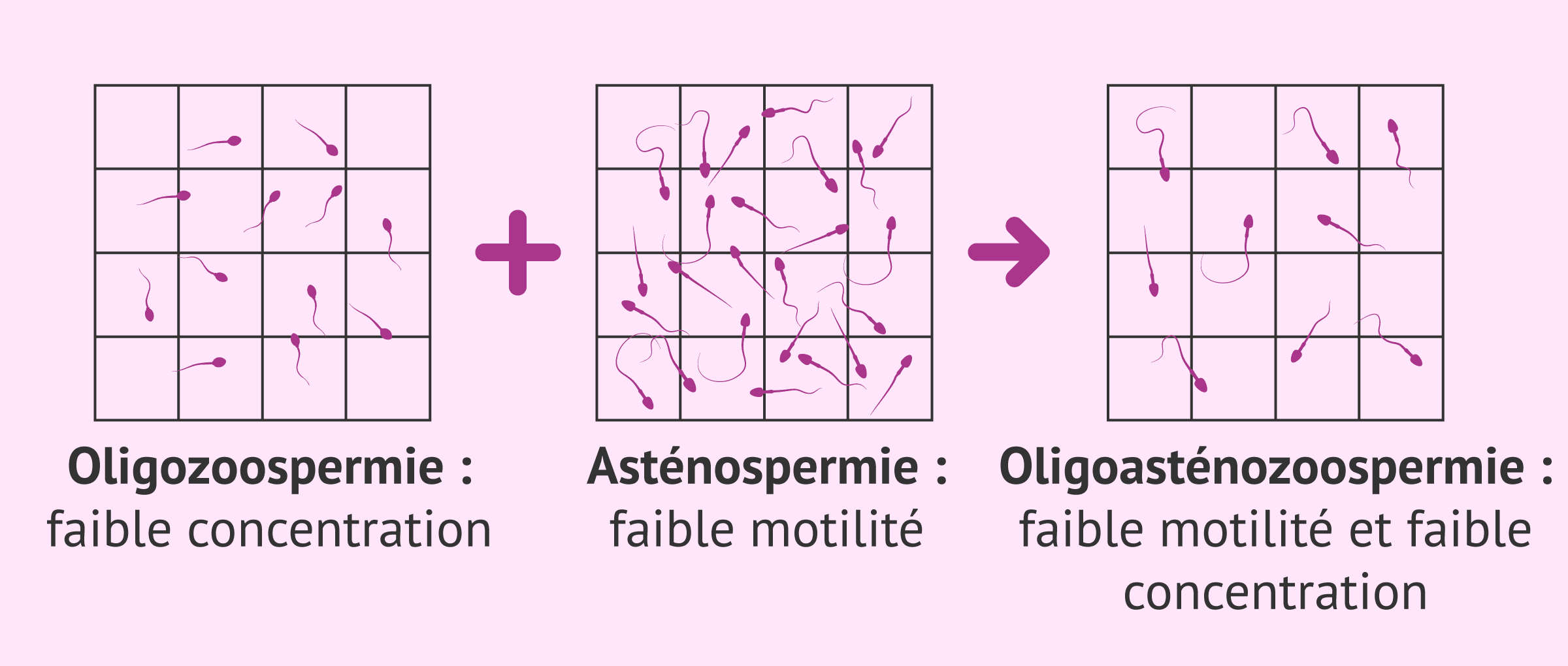 Imagen: Altération séminale : oligoasthénozoospermie