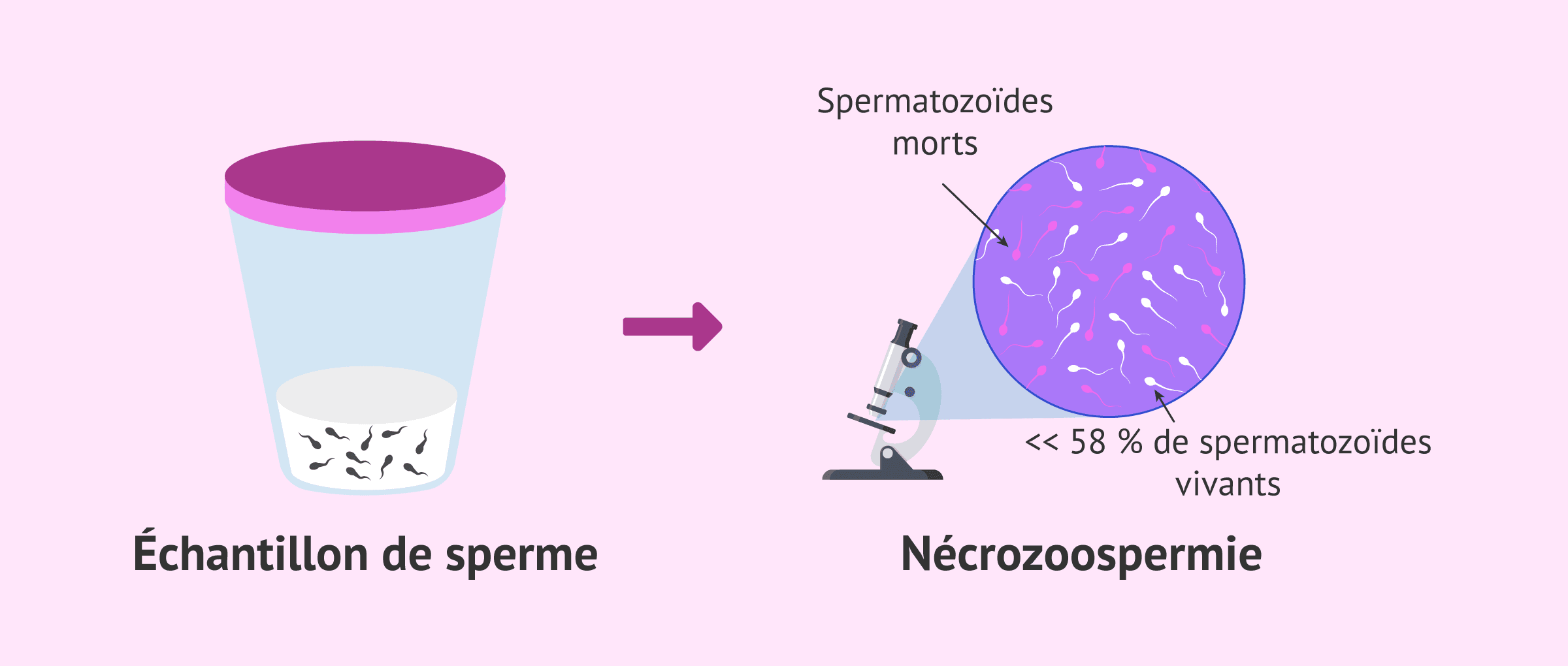 Imagen: Stérilité masculine due à la nécrozoospermie