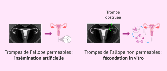 Imagen: Traitement de fertilité selon le résultat de l'HSG