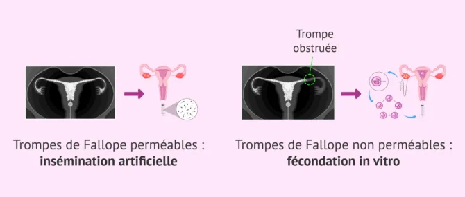 Imagen: Traitement de fertilité selon le résultat de l'HSG