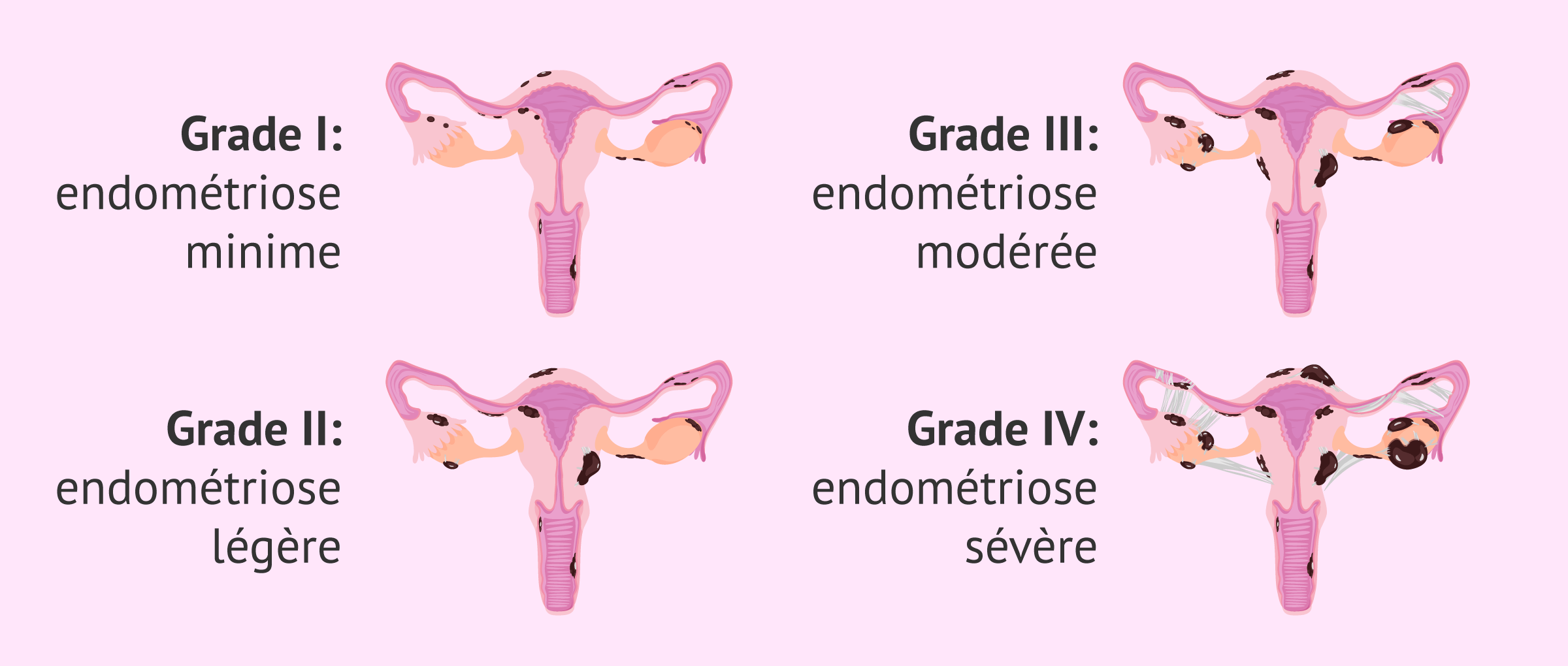 Quels sont les degrés de l'endométriose?