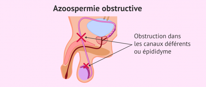Imagen: azoospermie obstructive