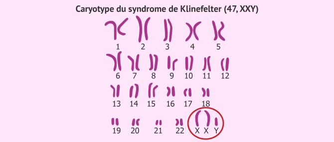 Imagen: Caryotype sindrome de klinefelter