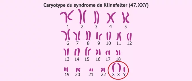 Imagen: Caryotype sindrome de klinefelter