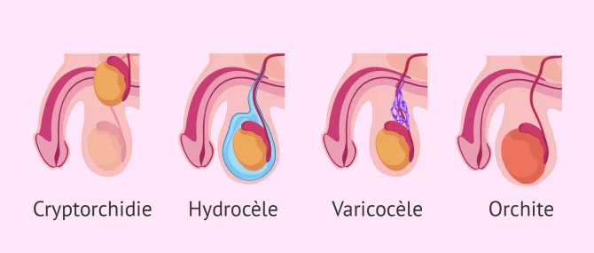 Imagen: causes testiculaires oligospermie