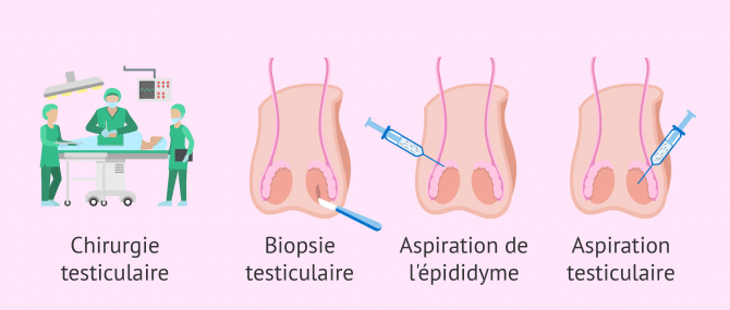 Imagen: chirurgie testiculaire