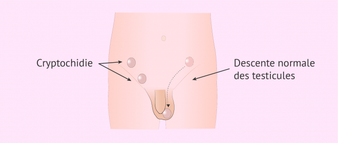 Imagen: Cryptorchidie