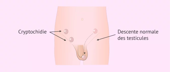 Imagen: Cryptorchidie