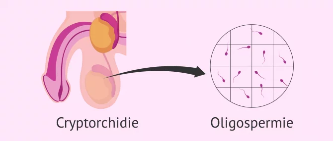 Imagen: Cryptorchidie oligospermie