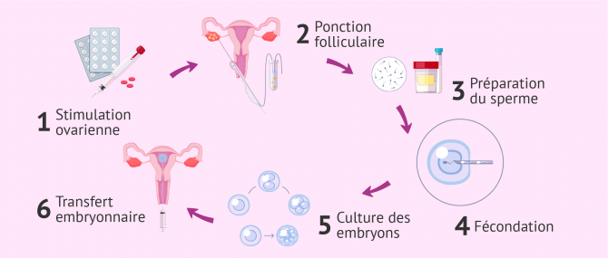 Imagen: FIV avec don de sperme