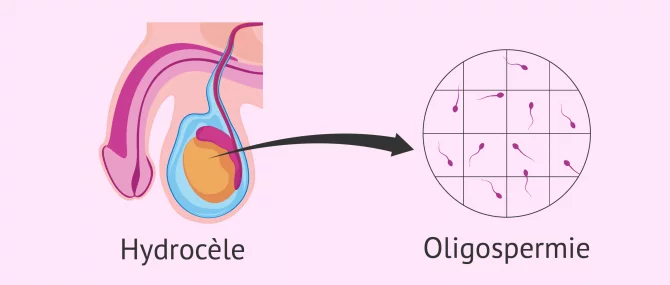 Imagen: Hidrocele oligospermie